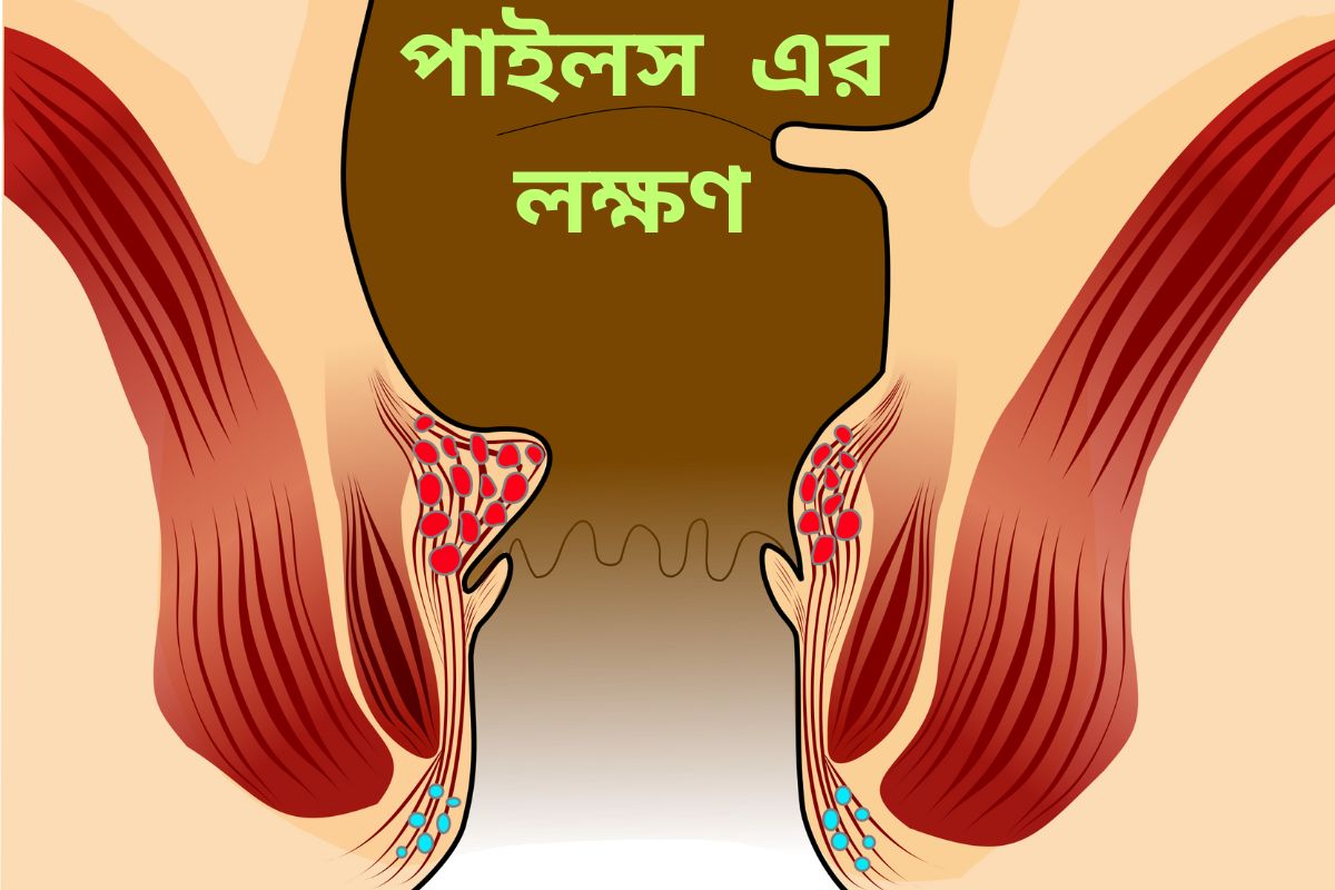 Symptoms of piles